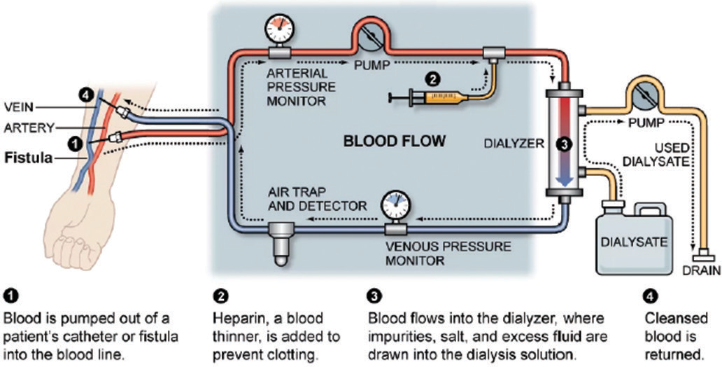 Temperature Monitoring in Hemodialysis | By Thermometrics